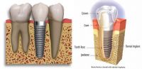 Implante dental 4.2mm
